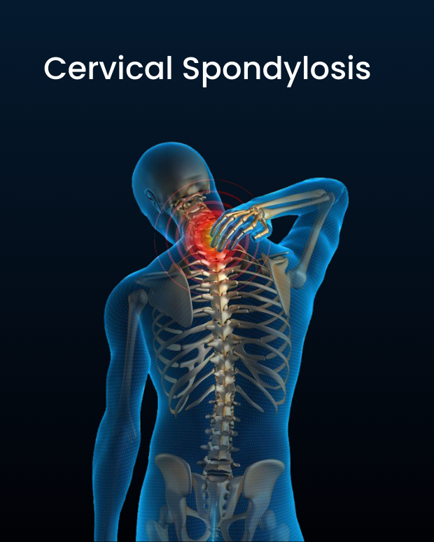 Cervical Spondylitis
