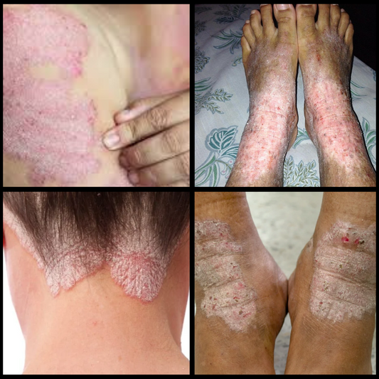 Eczema (Vicharchika)