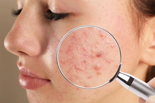 Acne? The Most Common Problem